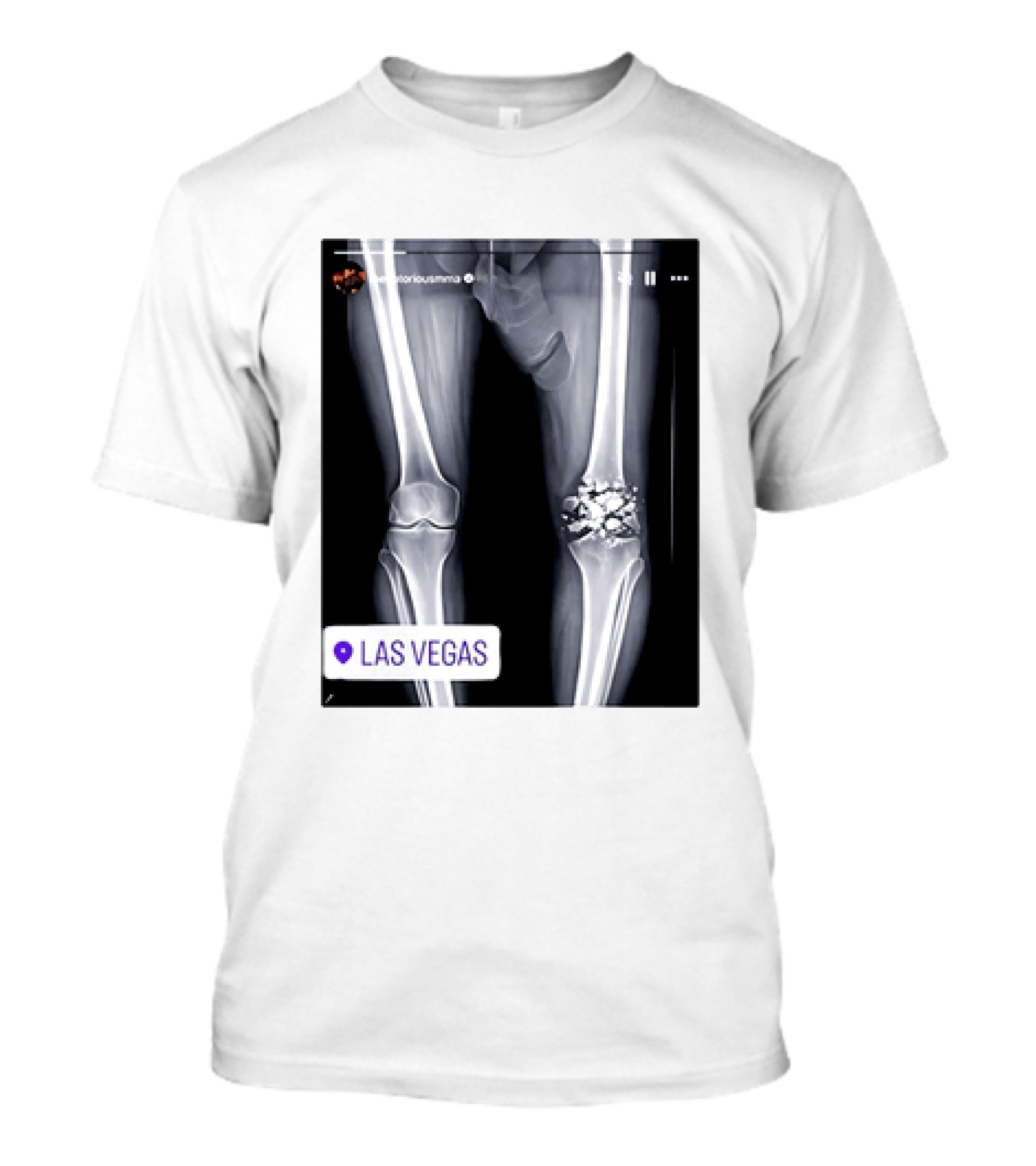 Conor McGregor X Ray Broken Knee Las Vegas T-Shirt