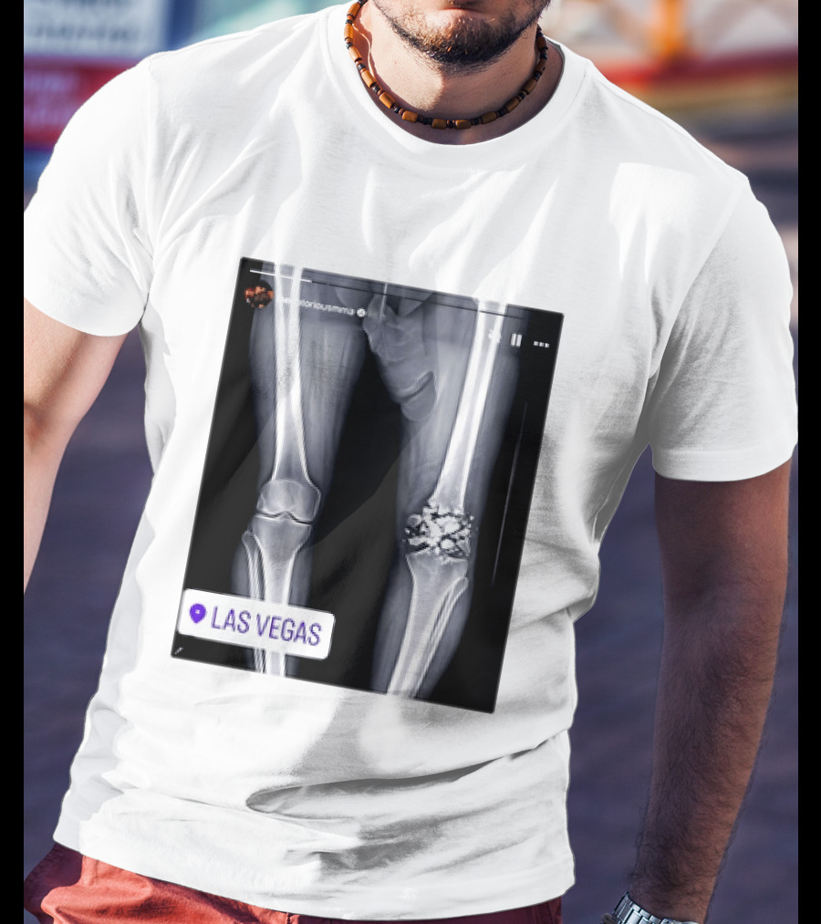 Conor McGregor X Ray Broken Knee Las Vegas T-Shirt